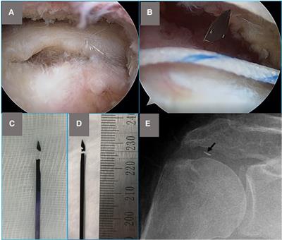 Mechanical mechanism of suture passer needle break in rotator cuff repair